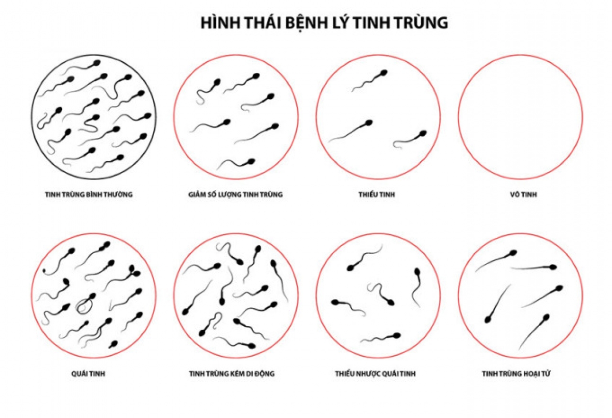 Xét nghiệm tinh dịch đồ sẽ cho biết chất lượng tinh trùng của đàn ông