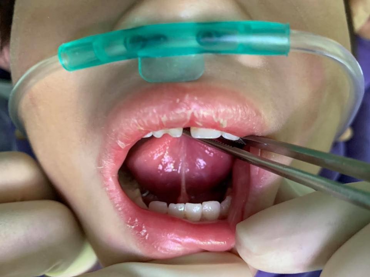 Trường hợp trẻ bị dính lưỡi chưa can thiệp- Ảnh: BVCC