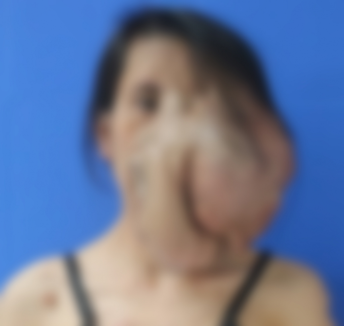 Bệnh nhân P. người có khối u khổng lồ vùng mặt trước khi được phẫu thuật