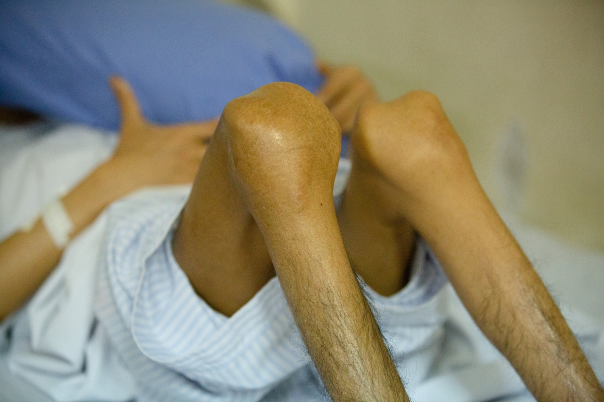 Người bệnh hemophilia bị chảy máu cơ khớp tái phát nhiều lần dẫn tới biến dạng khớp, teo cơ