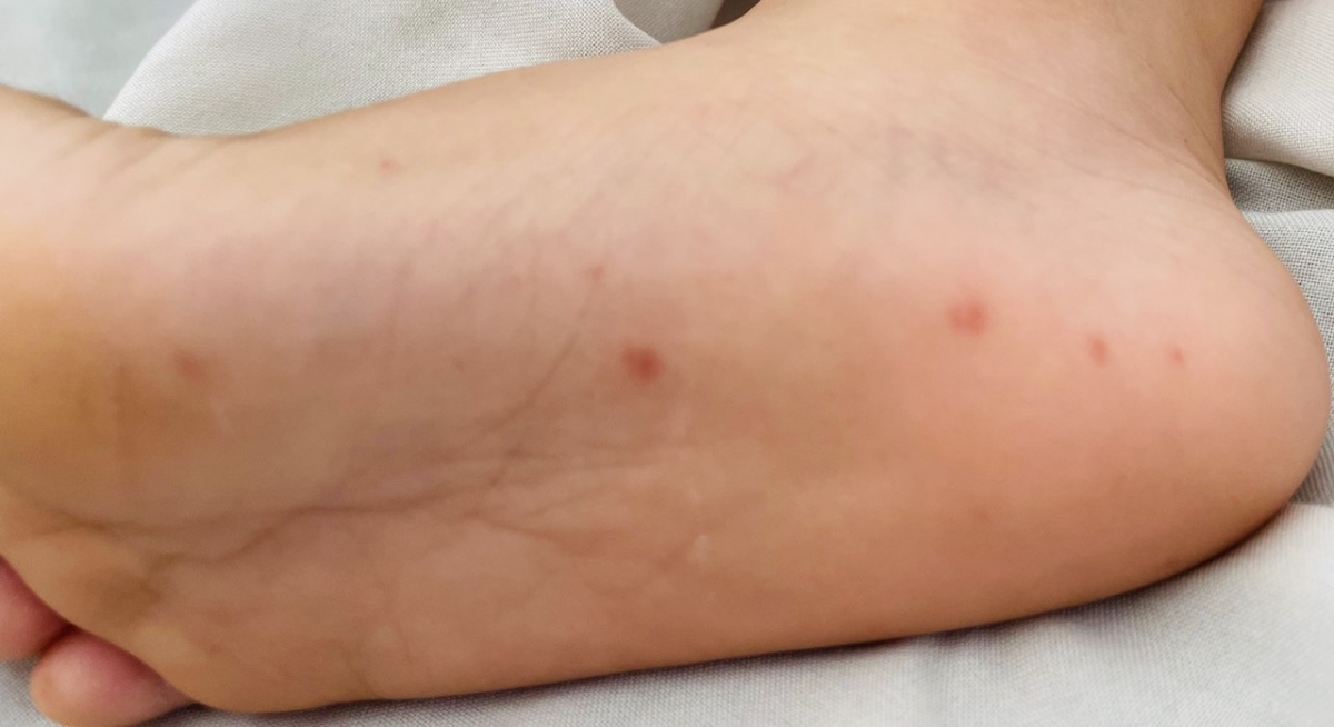 5 tháng đầu năm nay, cả nước ghi nhận gần 9.000 trường hợp mắc tay chân miệng