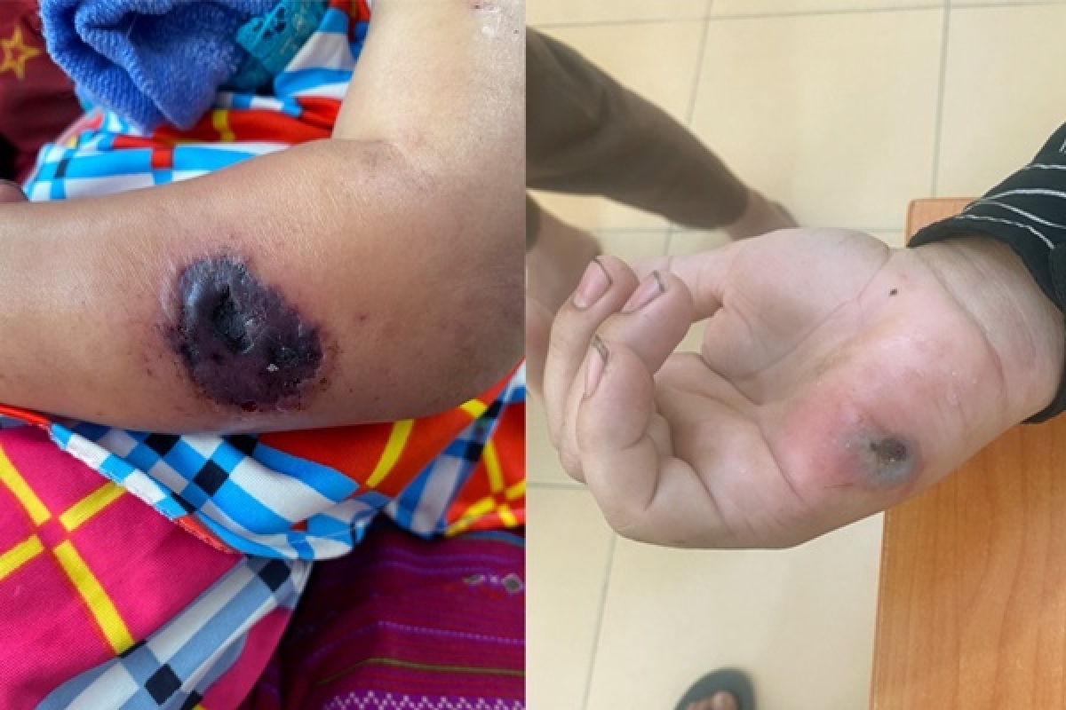 Hình ảnh tổn thương trên da bệnh nhân mắc bệnh than. Ảnh CDC Điện Biên