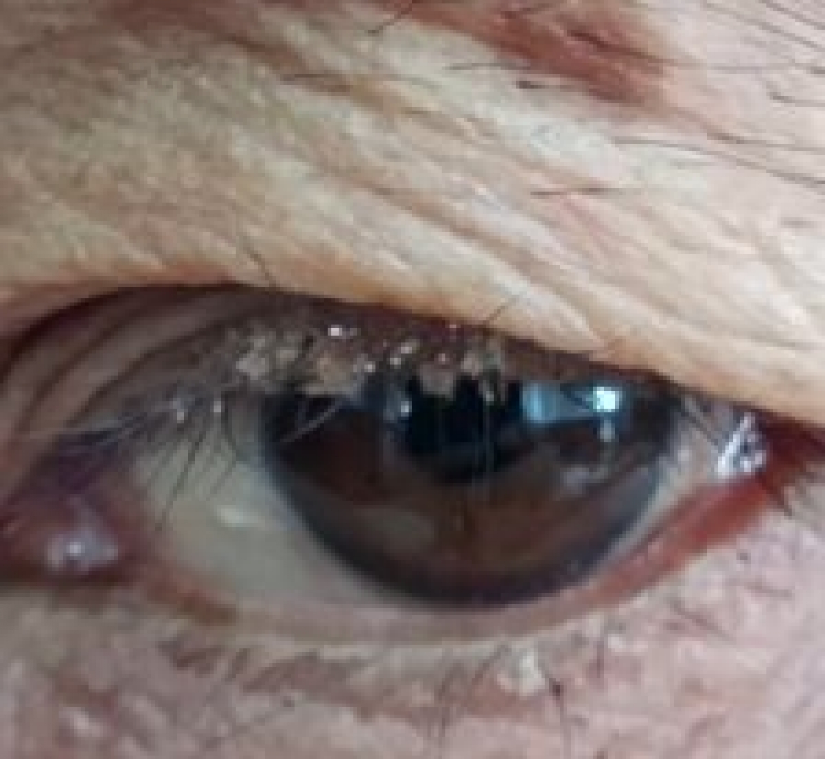 Nhiều người bệnh lầm tưởng bị viêm bờ mi khi mắc rận mu trên mi mắt
