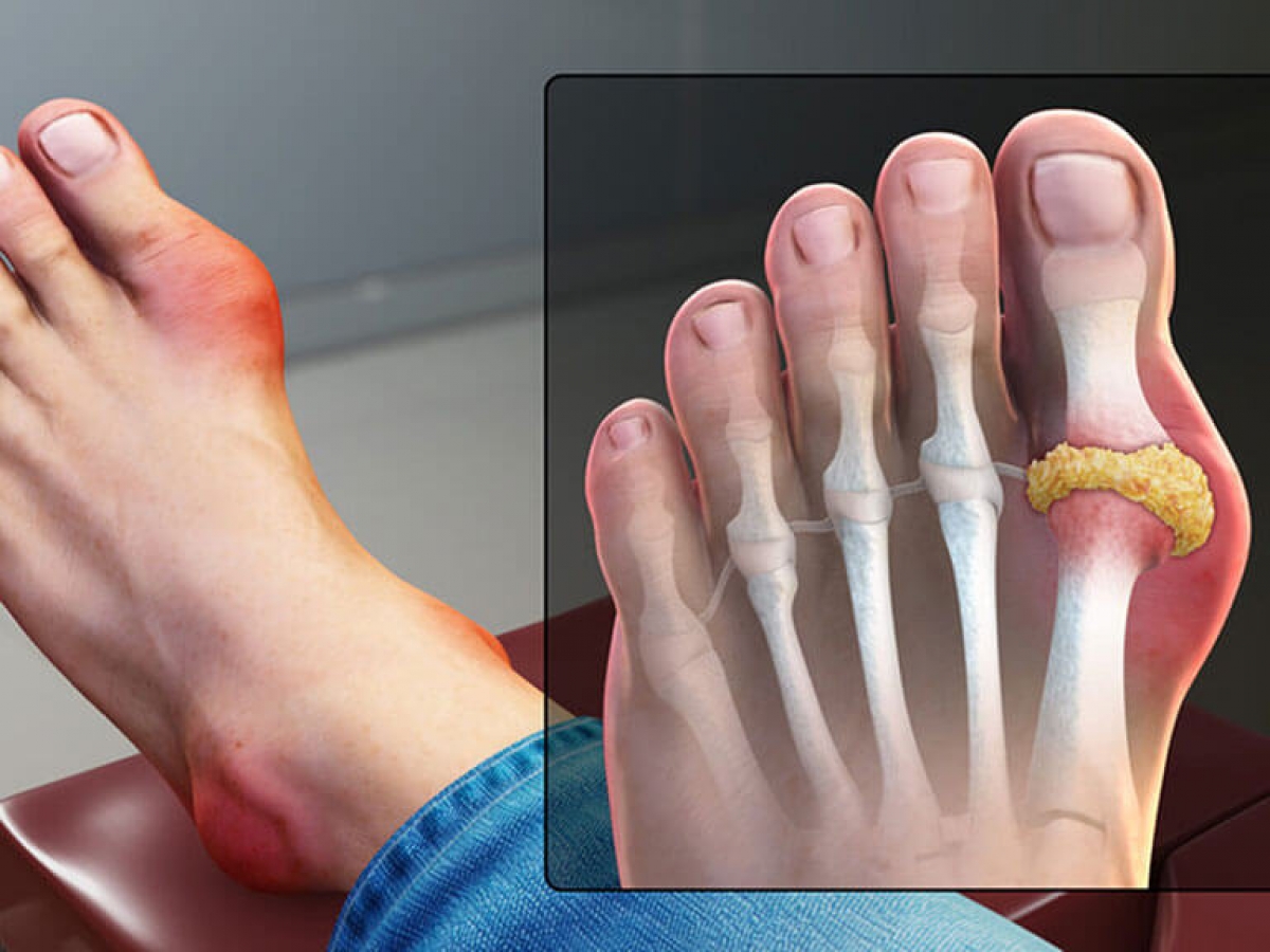 Nồng độ acid uric tăng cao trong máu kéo dài có thể gây bệnh gout