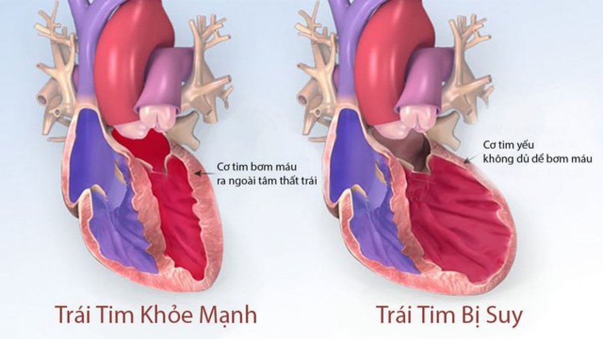 Hình ảnh quả tim bình thường và tim bị suy