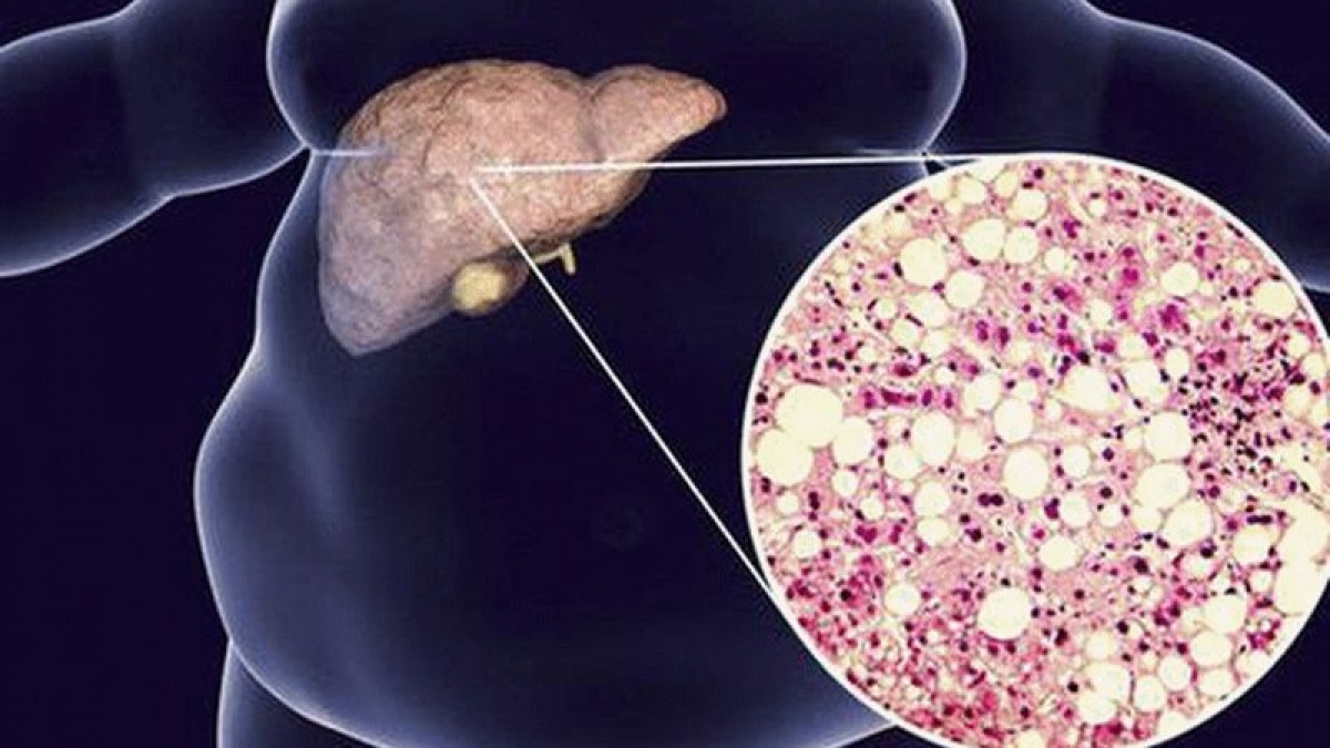 Men gan tăng cao làm giảm tuổi thọ con người