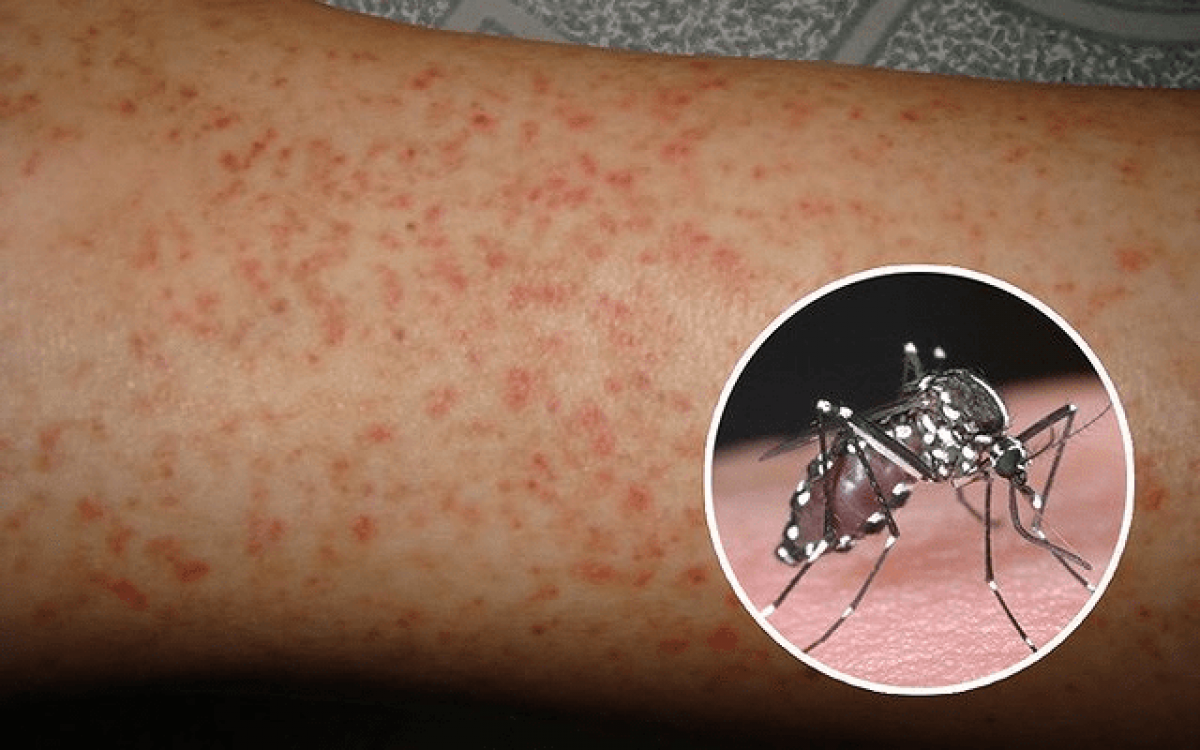 Mắc sốt xuất huyết lần sau có nguy cơ cao gặp biến chứng nguy hiểm hơn lần đầu