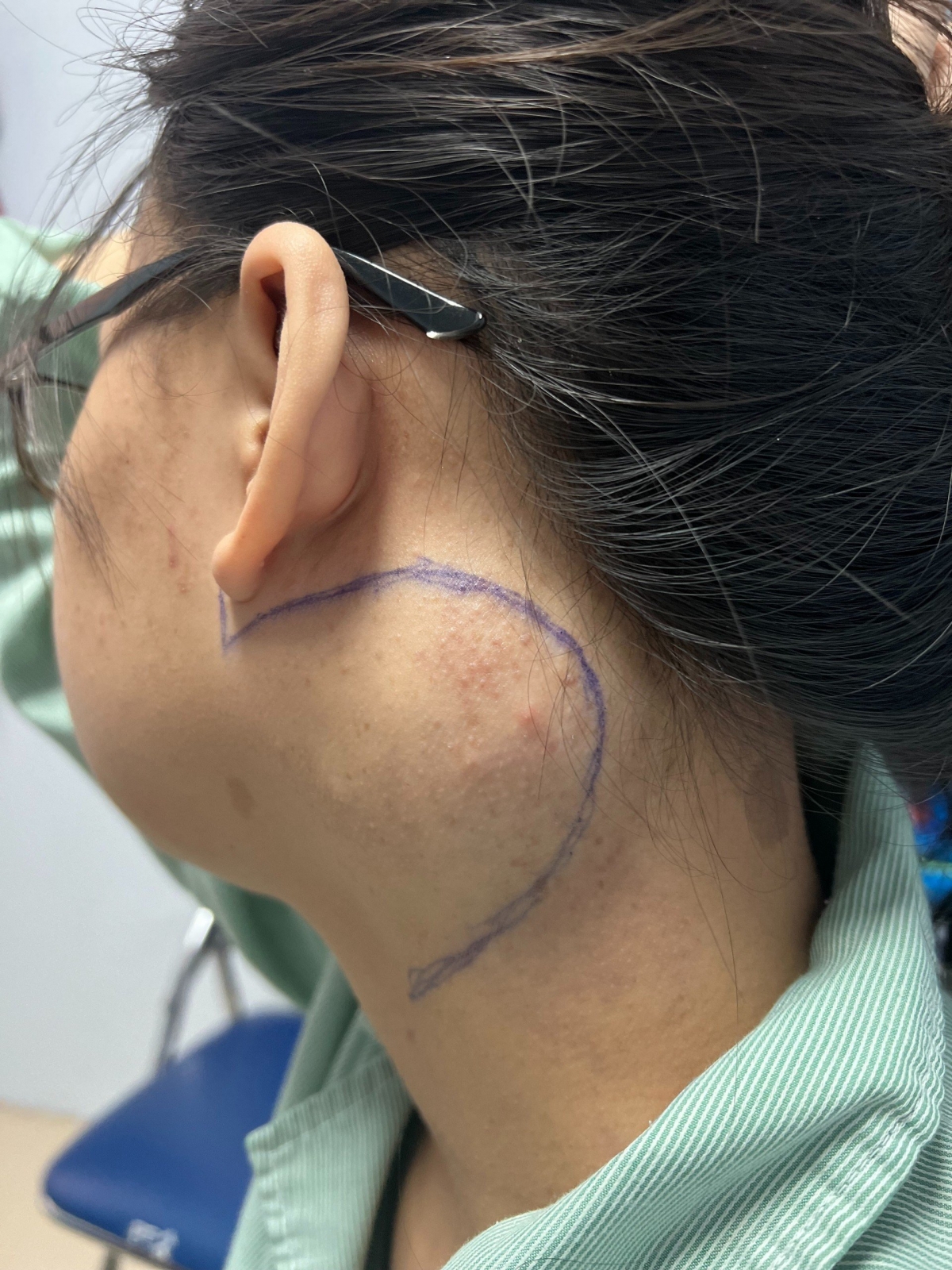 Bệnh nhân T.H. đã mang khối u suốt 7 năm qua