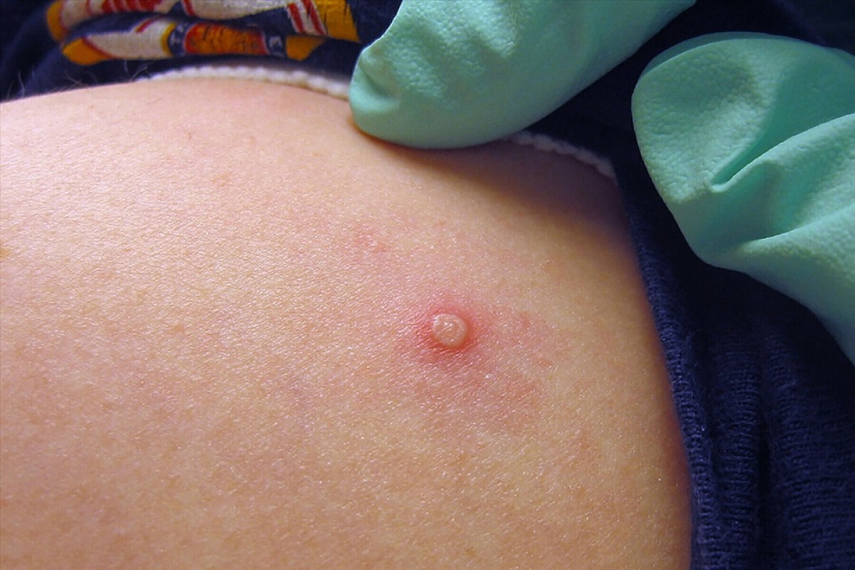 Chưa có bằng chứng về độc lực và sự lây lan của virus gây bệnh ở nam thanh niên 25 tuổi tại TP.HCM