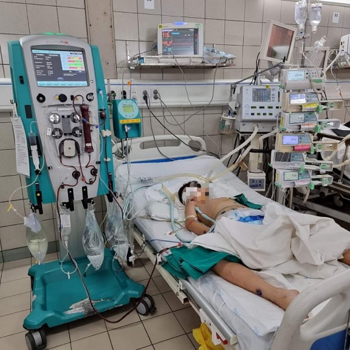Bệnh nhi được chỉ định lọc máu liên tục ngay tại Trung tâm Nhi khoa
