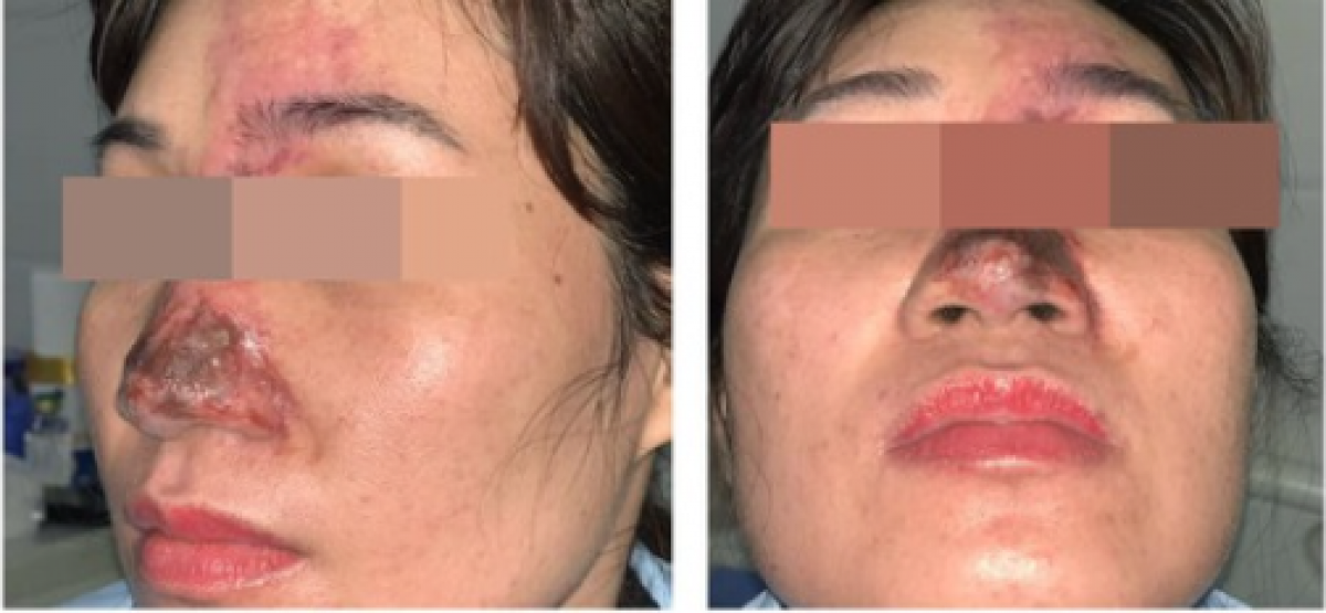 Một trường hợp tiêm filler nâng mũi bị biến chứng suýt gây mù mắt