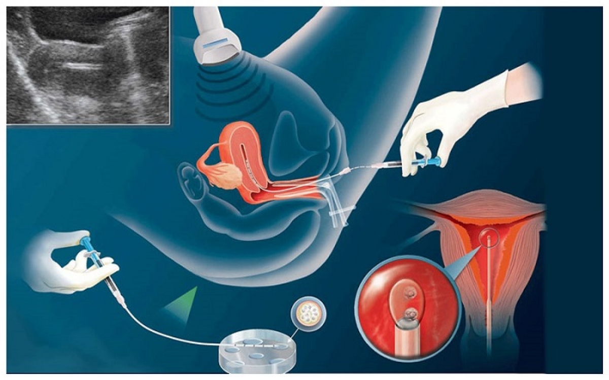 Trung bình chi phí cho một chu kỳ làm thụ tinh ống nghiệm khoảng 50 đến 70 triệu đồng