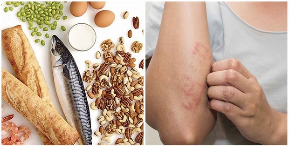 Nổi mề đay là một trong những biểu hiện của dị ứng thức ăn.