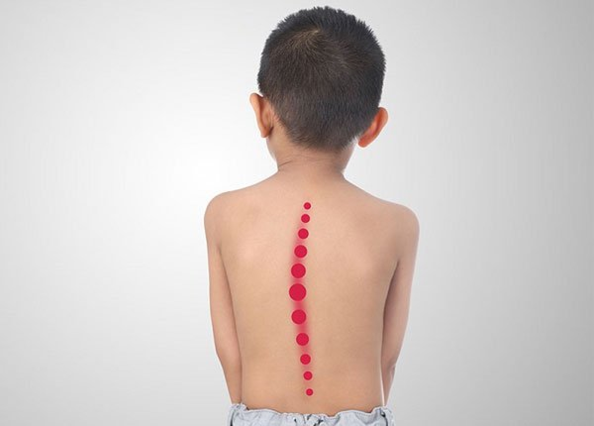 Trẻ bị cong vẹo cột sống thường gầy gò và đầu hơi bị lệch sang bên