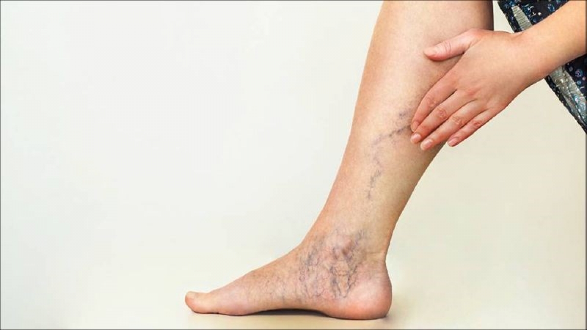 Người bị suy tĩnh mạch chi dưới nên đi bộ nhưng không nên ngâm chân nước nóng