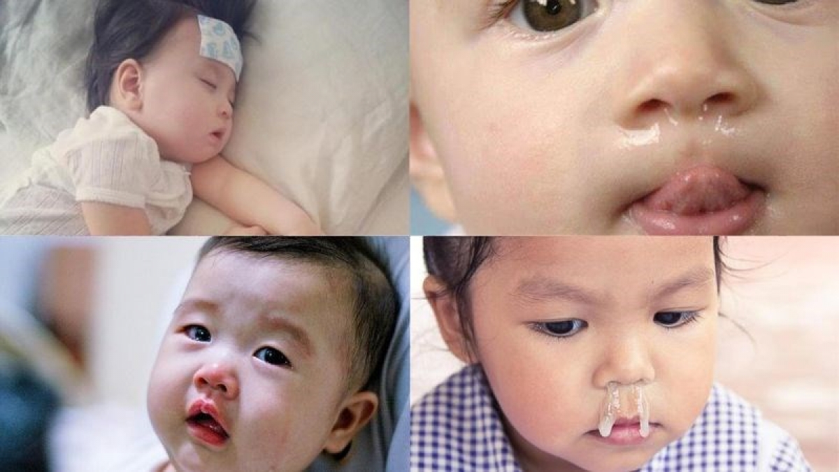 Viêm VA gây ảnh hưởng đến sức khỏe của trẻ nhỏ Ảnh: Internet