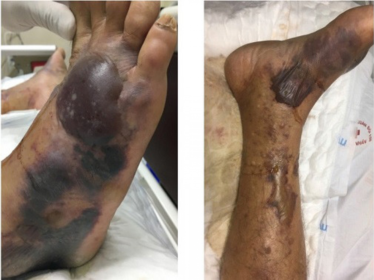 Một bệnh nhân bị nhiễm trùng máu do vi khuẩn Vibrio vulnificus. (Ảnh: PV/Vienam+)