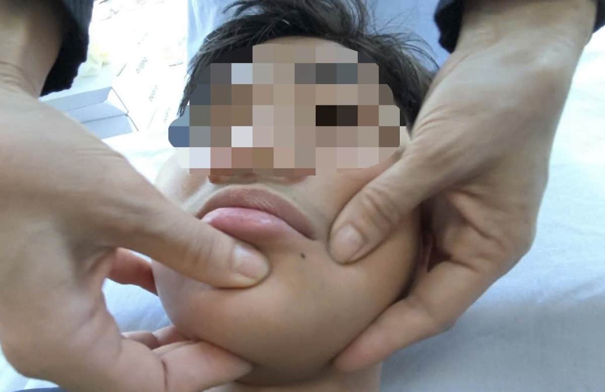 Bệnh nhân bị liệt dây thần kinh số 7 đang điều trị tại Bệnh viện Bệnh nhiệt đới TW (ảnh: BVCC)